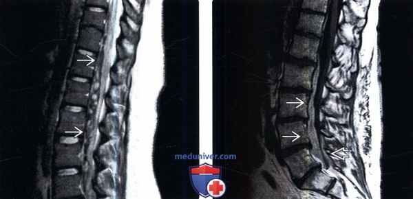 МРТ при субдуральной гематоме позвоночника
