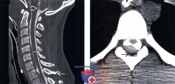 КТ, МРТ при субдуральной гематоме позвоночника