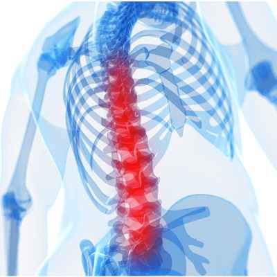 Эпидуральная гематома спинного мозга