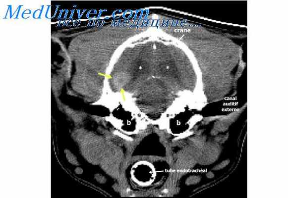 эпидуральные метастазы