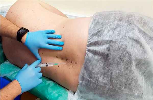 блокада позвоночника