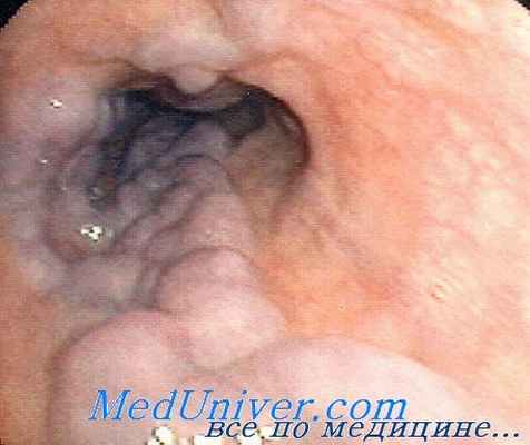 портальная гипертензия