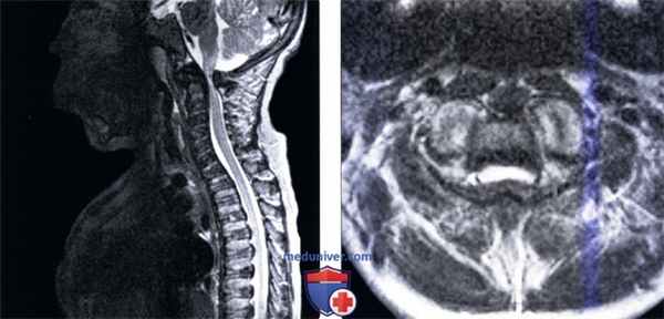 МРТ позвоночника при спондилоэпифизарной дисплазии