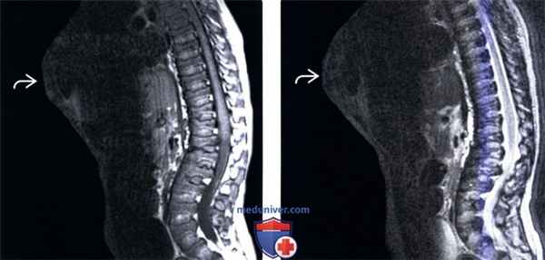 МРТ позвоночника при спондилоэпифизарной дисплазии