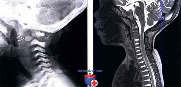 Рентгенограмма, МРТ позвоночника при спондилоэпифизарной дисплазии