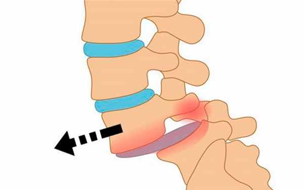 Спондилолистез