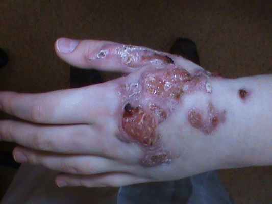 Кожно-лимфатический споротрихоз: клинический случай