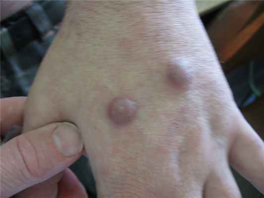 Кожно-лимфатический споротрихоз: клинический случай