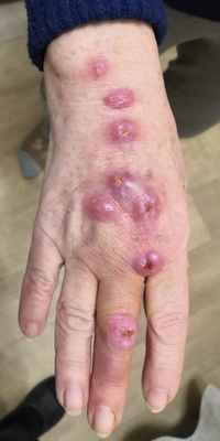 Кожно-лимфатический споротрихоз: клинический случай