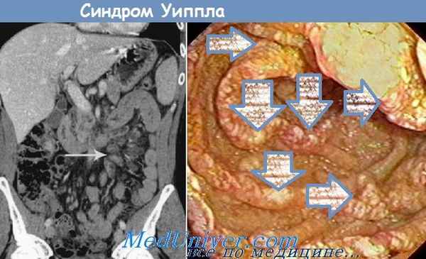 синдром Уиппла