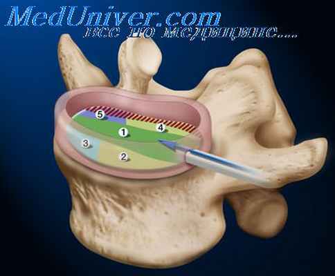 стабилизация позвоночника