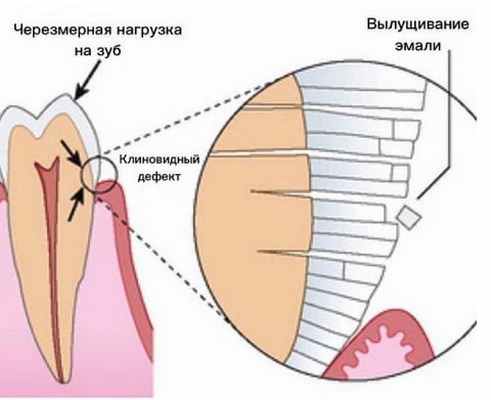 клиновидный дефект