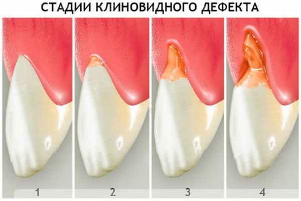клиновидный дефект