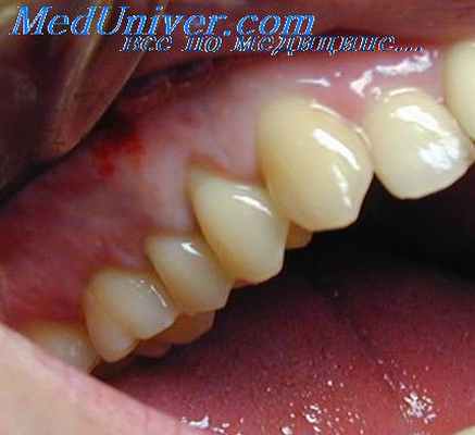 протезирование зубов