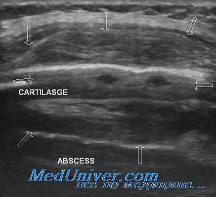стадии эксудативного плеврита