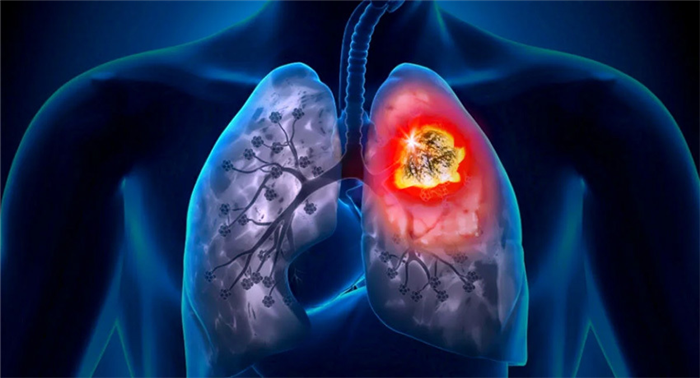 Показания для плевральной пункции