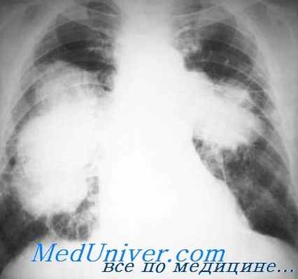 силикотуберкулез