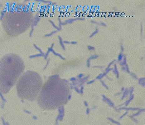 ларвальный парагонимоз