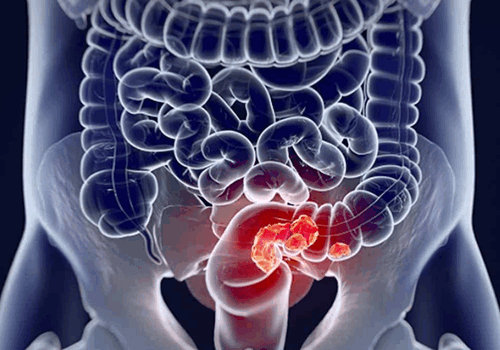 рак прямо кишки