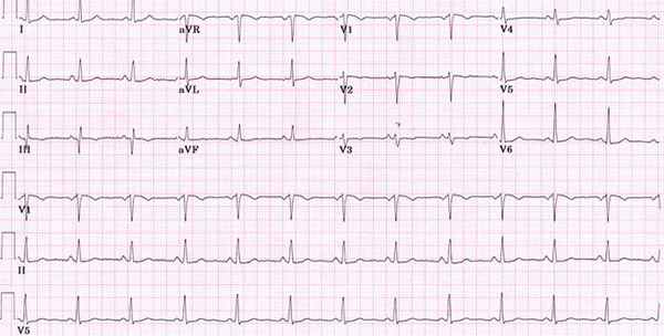 электрокардиограмма