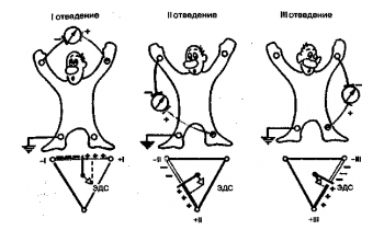 Формирование трех стандартных электрокардиографи­ческих отведений от конечностей. Внизу - треугольник Эйнтховена, каждая сторона которого является осью того или иного стандартного отведения