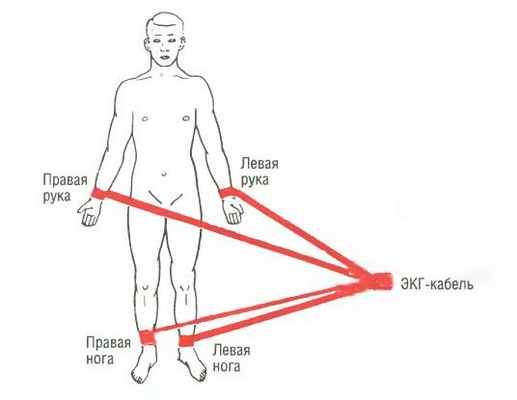 Электроды для записи электрокардиограммы