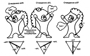 Формирование трех усиленных однополюсных отведе­ний от конечностей. Внизу - треугольник Эйнтховена и расположение осей трех усиленных однополюсных отведений от конечностей.