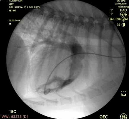 Рис. 1 Контрастирование выводного тракта правого желудочка. Стеноз клапана легочной артерии..JPG