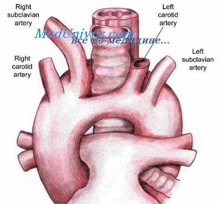 стеноз легочной артерии