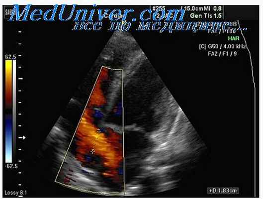 стеноз легочной артерии