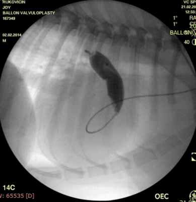 Рис. 3 Баллонопластика.jpg