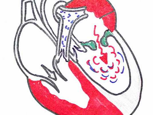 Фото Митральный стеноз