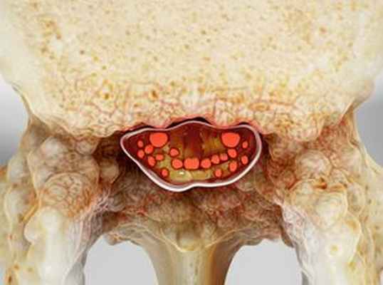 Стеноз (сужение) позвоночного канала