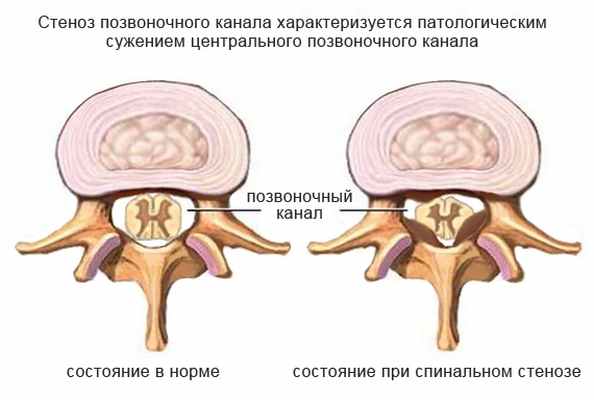 поясничный стеноз
