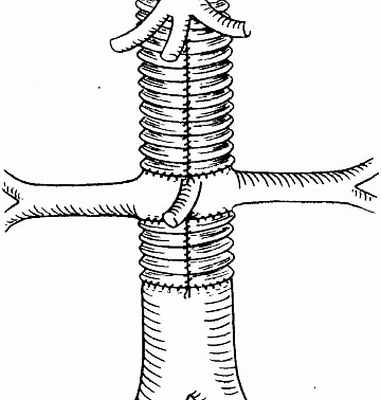 Фото Стеноз аорты
