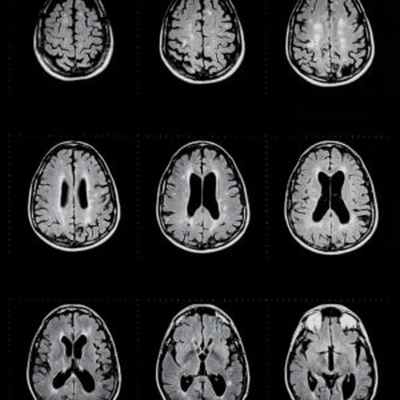Гидроцефалия в Германии