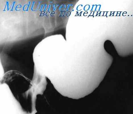 стеноз желудка