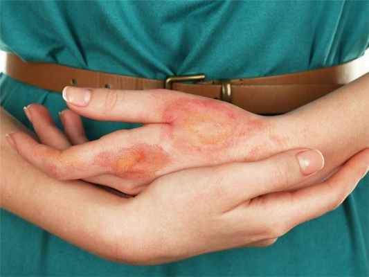 Классификация ожогов