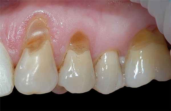 Клиновидный дефект