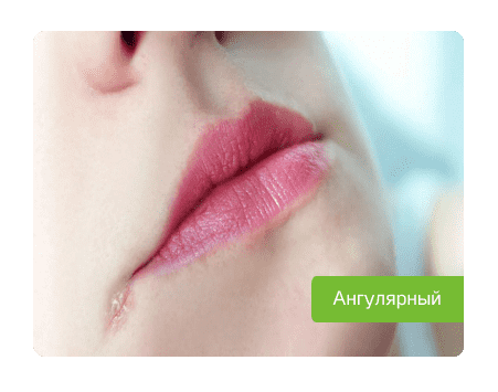 ангулярный стоматит