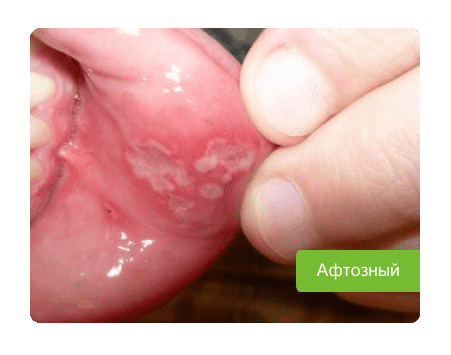 афтозный стоматит