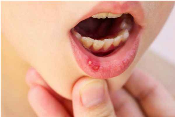 Симптомы и лечение стоматита у детей