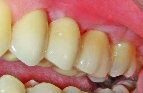 протезный стоматит 03
