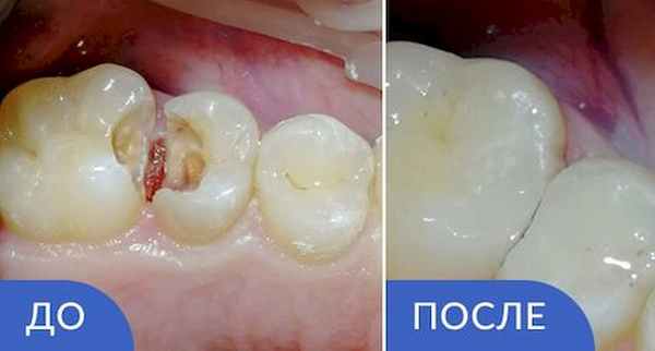 Кариес зубов лечение
