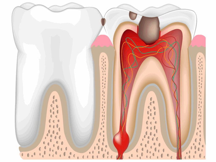 Воспаление корня зуба: симптомы, лечение, профилактика
