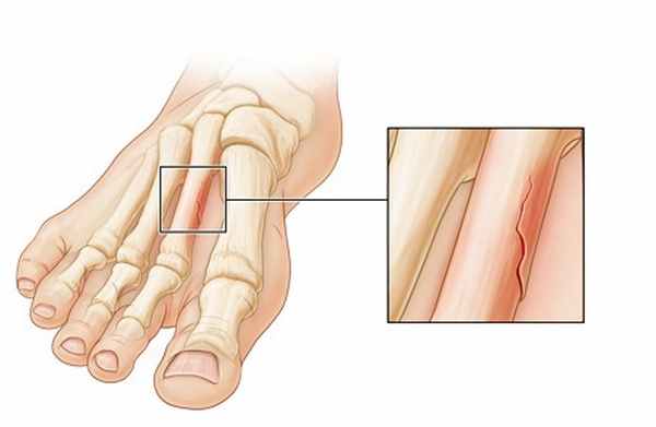 Усталостный перелом: что это, профилактика, лечение