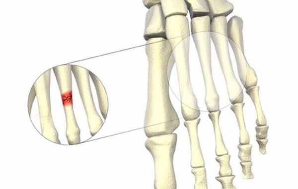 Гид по беговым травмам: стресс-перелом