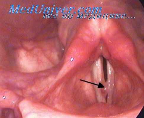 ларингостробоскопия