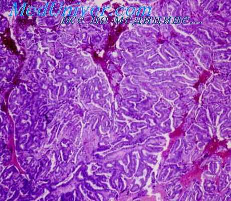 карциноид яичника