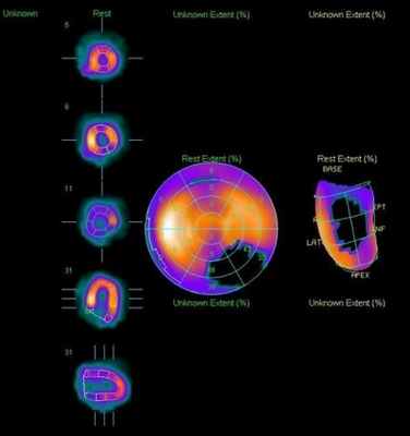 сцинтиграфия миокарда в покое